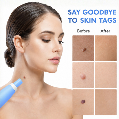 TagBuddy™ | Skin Tag Remover Kit