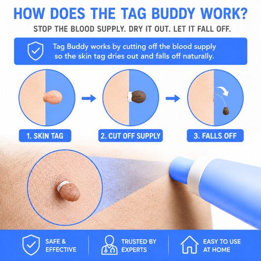 TagBuddy™ | Skin Tag Remover Kit